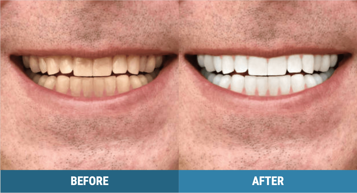Does zoom teeth whitening damage enamel
